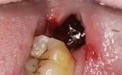 拔牙干槽症可怕吗？