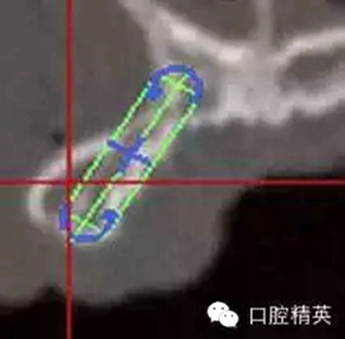 口腔种植各种失败模式的病因探查