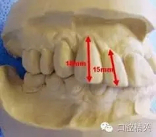 口腔种植各种失败模式的病因探查