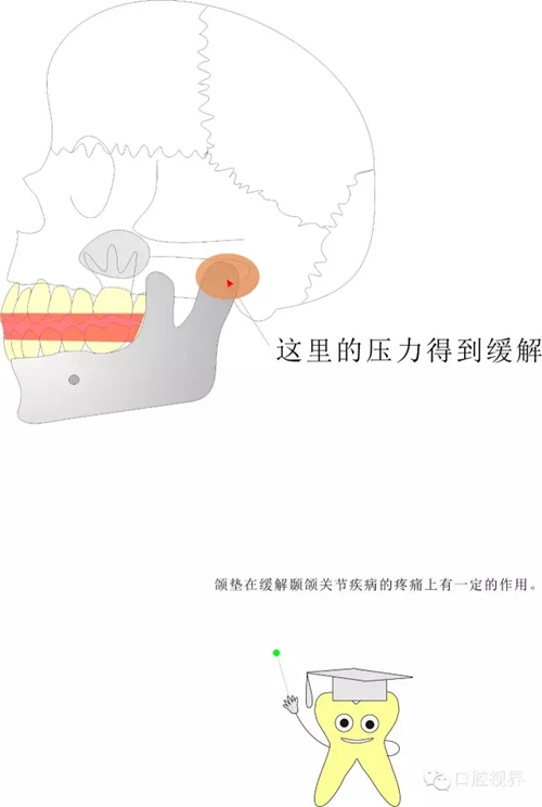 【爱牙科普知识300问】 “什么是颌（牙）垫？”