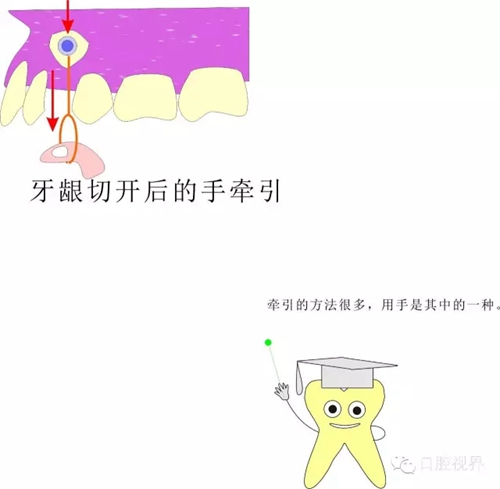 【爱牙科普知识300问】 “什么是颌（牙）垫？”