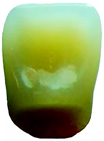 舌侧釉质层.png