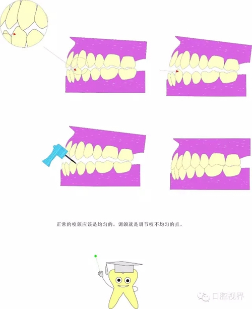 【爱牙科普知识300问】 “什么是牙间牵引？”