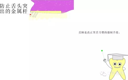 【爱牙科普知识300问】 “什么是牙间牵引？”