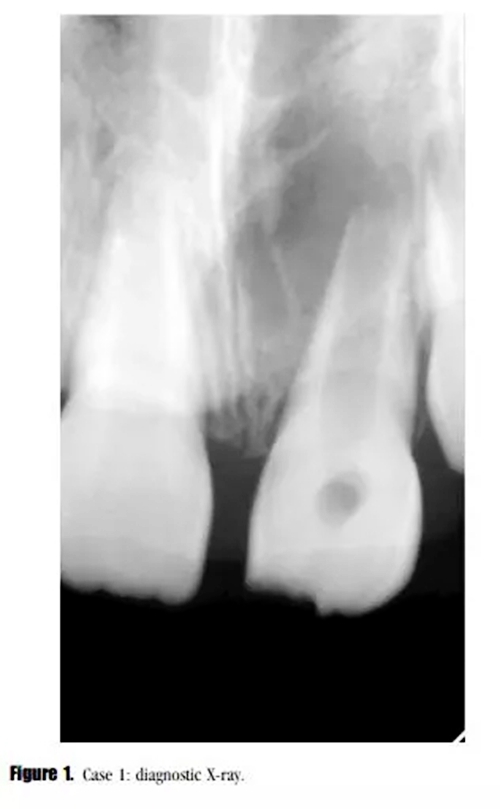 病例分享｜牙髓血管再生治疗失败后的牙根发育：2例