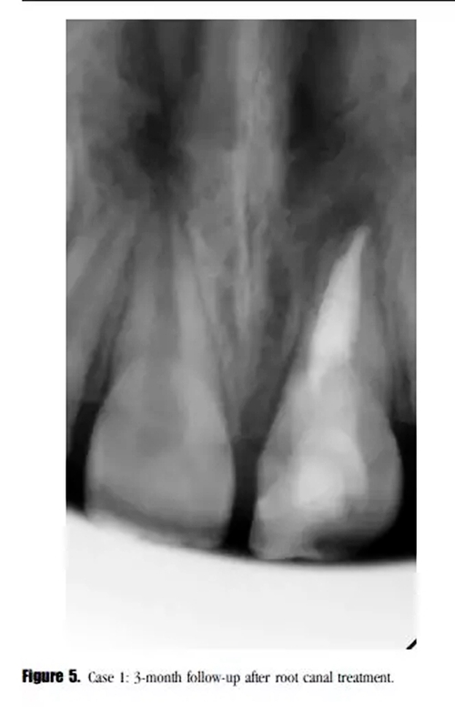 病例分享｜牙髓血管再生治疗失败后的牙根发育：2例