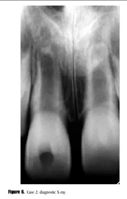 病例分享｜牙髓血管再生治疗失败后的牙根发育：2例