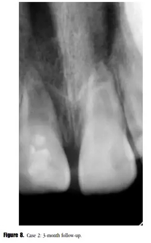 病例分享｜牙髓血管再生治疗失败后的牙根发育：2例