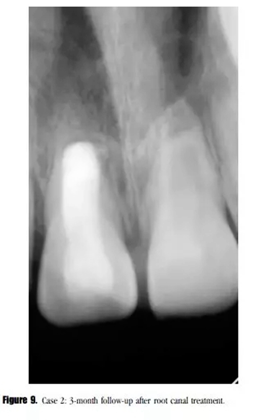 病例分享｜牙髓血管再生治疗失败后的牙根发育：2例
