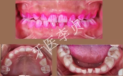儿牙病例|儿童蛀牙的修复