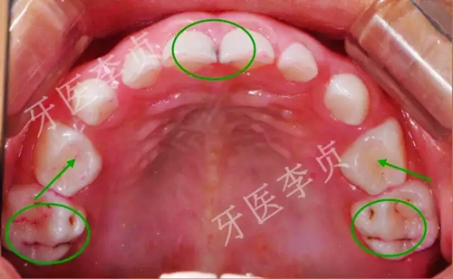 儿牙病例|儿童蛀牙的修复