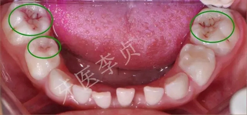 儿牙病例|儿童蛀牙的修复