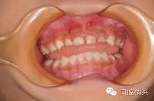 全麻下儿科治疗+儿牙树脂充填