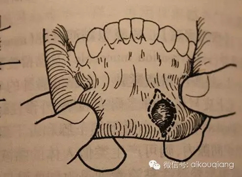 粘液腺囊肿