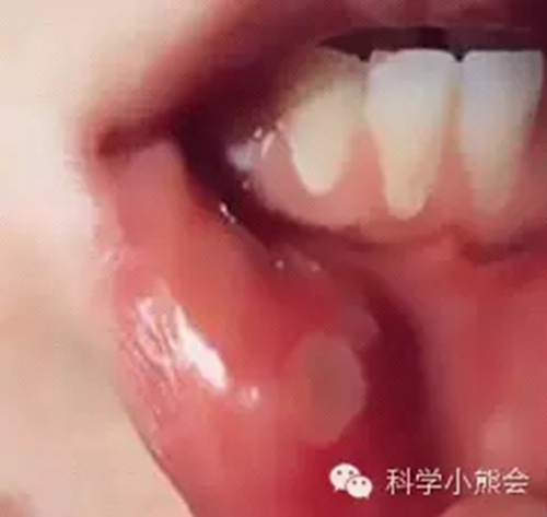 粘液腺囊肿