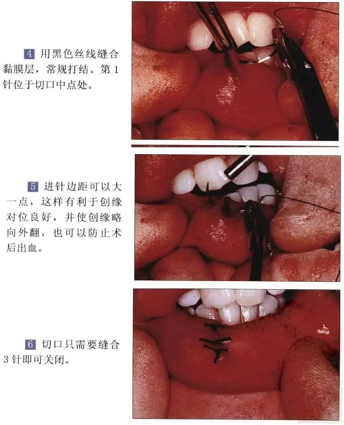 粘液腺囊肿切除术