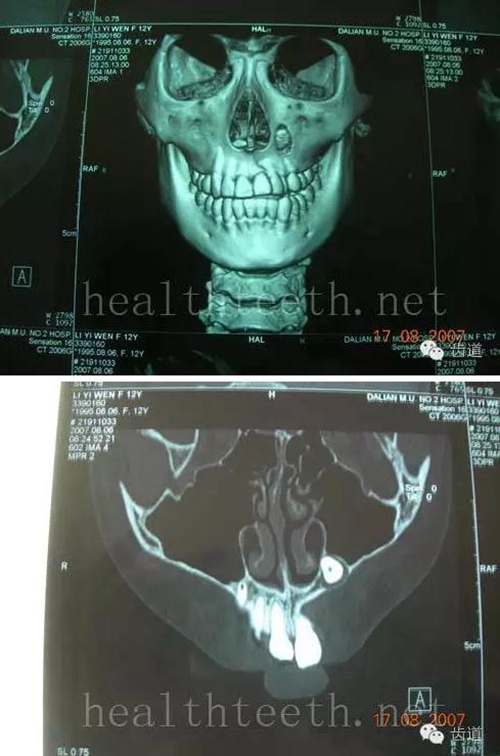 通过ct片确定埋伏牙齿具体的位置,显示距离左侧上颌窦很近,偏唇侧,这