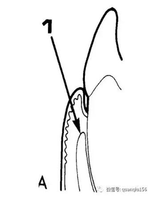 第一切口:内斜切口internal bevel incision