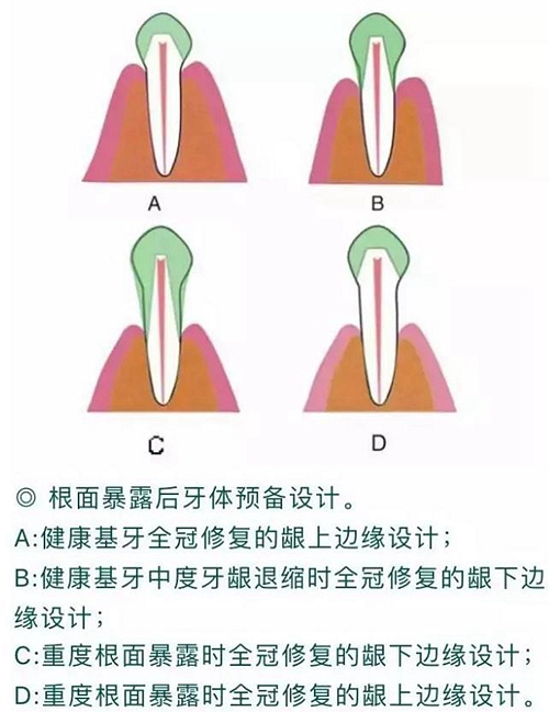 做全冠修复时基牙根面暴露，如何备牙？