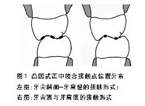 凸凹式后牙咬合接触及其临床意义 科贸嘉友收录|正畸