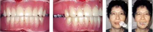全口拔牙即戴全口活动义齿修复病例 