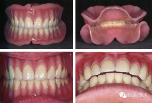 全口拔牙即戴全口活动义齿修复病例 