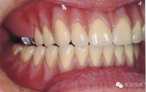 全口拔牙即戴全口活动义齿修复病例 