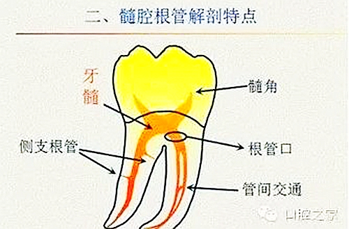 根管治疗之根管口的探查要点  