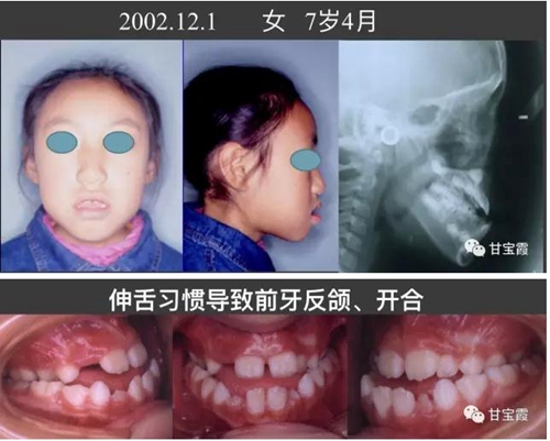 口腔不良习惯会引起牙颌畸形