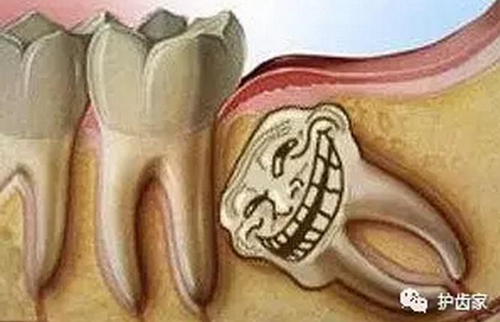 智齿一定要拔吗?