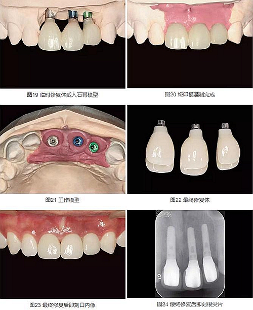 上颌多颗相邻前牙的“精确化”即刻种植修复