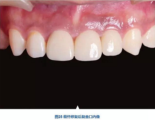 上颌多颗相邻前牙的“精确化”即刻种植修复