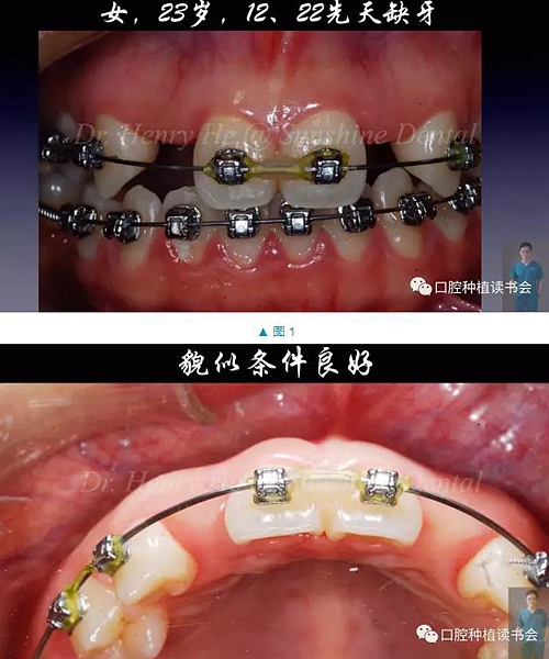 短种植体在前牙美学区应用的临床病例报道（上）