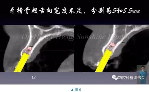 短种植体在前牙美学区应用的临床病例报道（上）