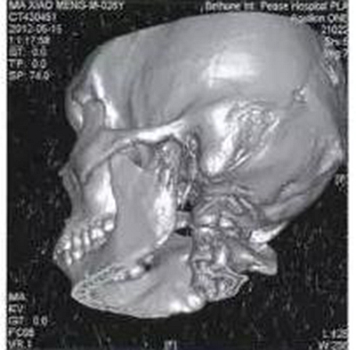 少见部位的下颌骨骨髓炎4例 
