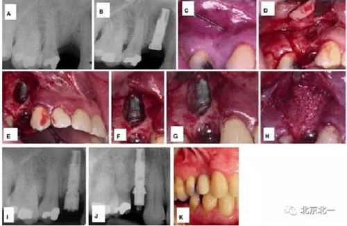 种植体根尖周病变的病因和治疗