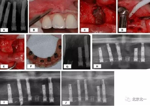种植体根尖周病变的病因和治疗