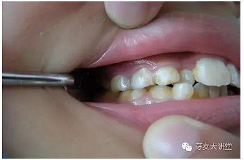 12岁前必须处理的20种儿童牙颌畸形【口腔科普】