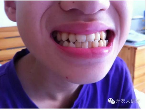 12岁前必须处理的20种儿童牙颌畸形【口腔科普】