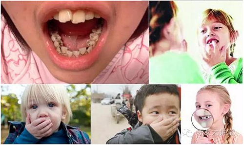 12岁前必须处理的20种儿童牙颌畸形【口腔科普】
