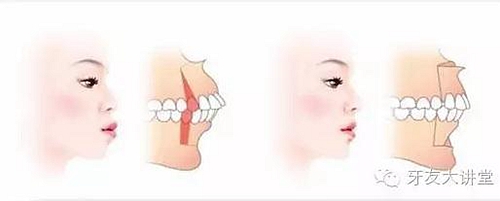 12岁前必须处理的20种儿童牙颌畸形【口腔科普】