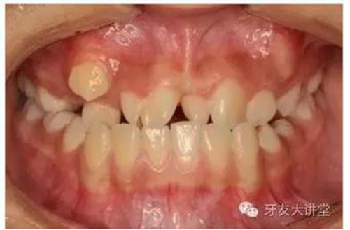 12岁前必须处理的20种儿童牙颌畸形【口腔科普】