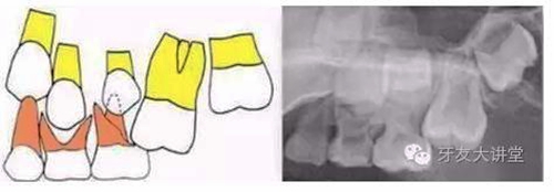 12岁前必须处理的20种儿童牙颌畸形【口腔科普】