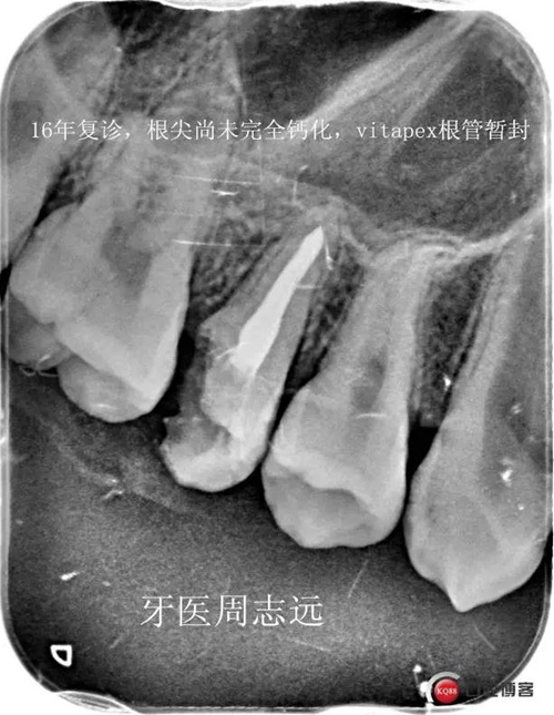 根尖诱导成型术   