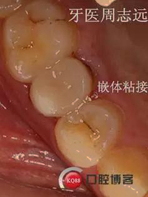 根尖诱导成型术   