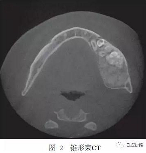 下颌骨骨化纤维瘤并发组合性牙瘤1例