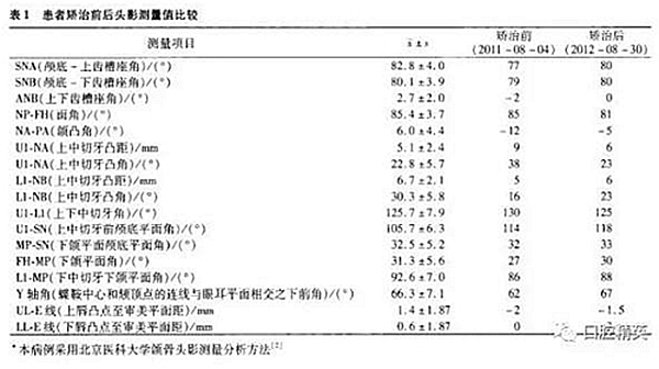 尖牙完全唇侧错位拥挤，矫正1例  