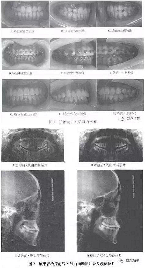 尖牙完全唇侧错位拥挤，矫正1例  