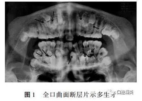 罕见多发性14颗多生牙1例