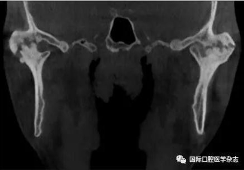 张清彬谈张口受限 